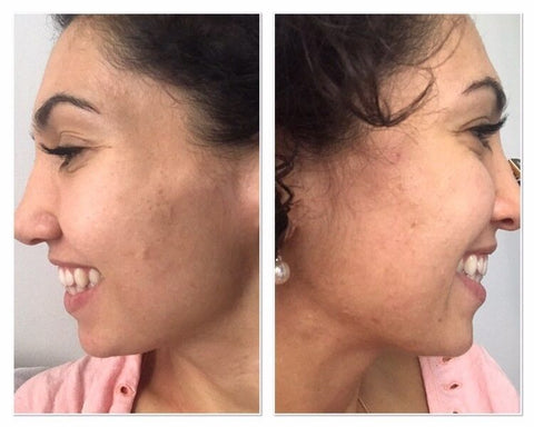 cure-detox-a-boire-anti-acne-peau-nette