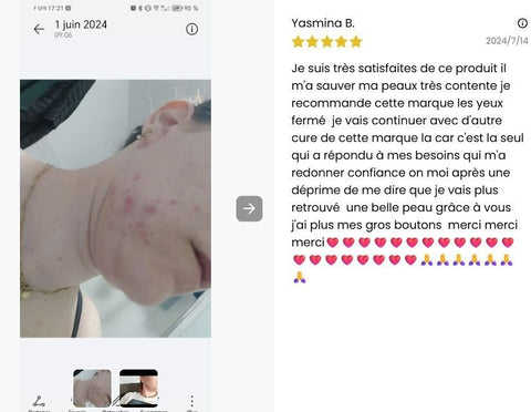 cure-detox-a-boire-anti-acne-peau-nette