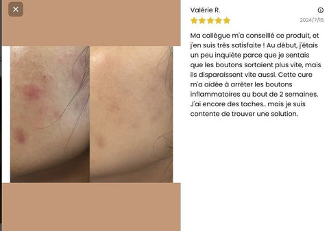 cure-detox-a-boire-anti-acne-peau-nette